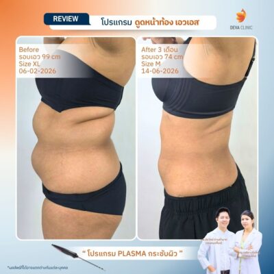 รีวิวหน้าท้อง - ดูดไขมัน วังหิน 5