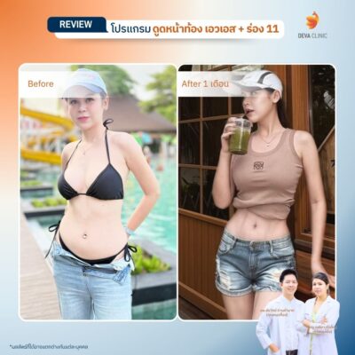 Deva Clinic รีวิวหน้าท้อง 1