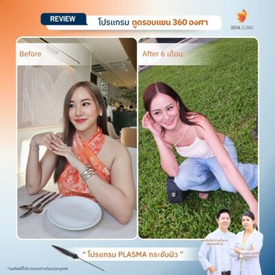 รีวิวต้นแขน - ดูดไขมัน วังหิน 8