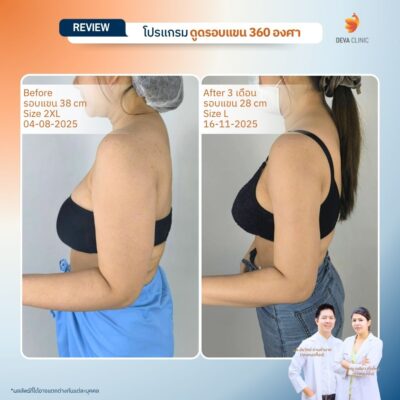 Deva Clinic รีวิวต้นแขน 20