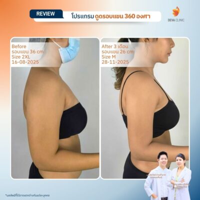 รีวิวต้นแขน - ดูดไขมัน วังหิน 7