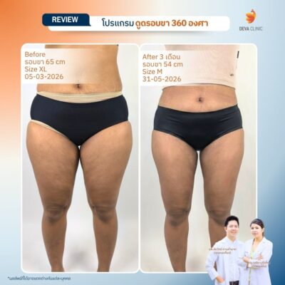 รีวิวดูดขา ดูดไขมัน เกษตรนวมินทร์ 11