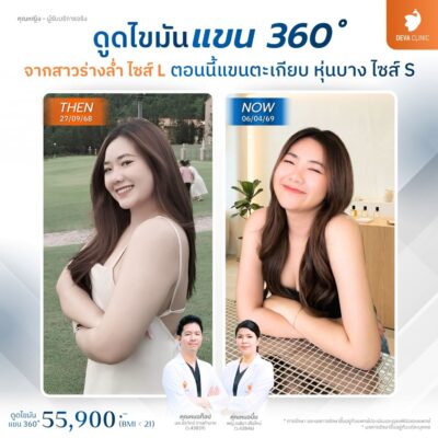ดีว่าคลินิก รีวิว ดูดไขมันต้นแขน 360 องศา คุณหญิง 02