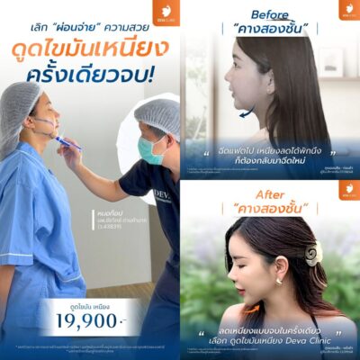 รีวิวดูดไขมันหน้า เหนียง ดีว่าคลินิก ดีไหม 04
