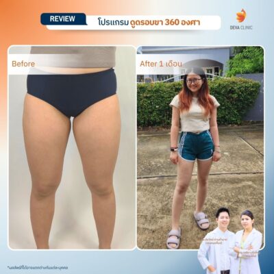 Deva Clinic รีวิวต้นขา 19