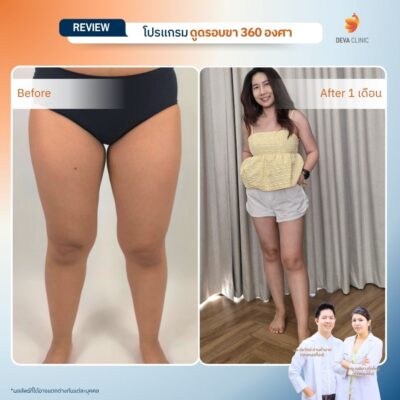 Deva Clinic รีวิวต้นขา 20