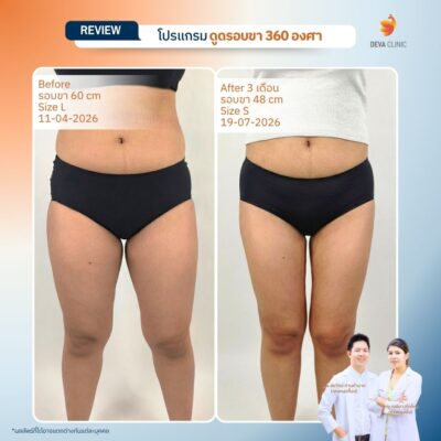 Deva Clinic รีวิวต้นขา 4