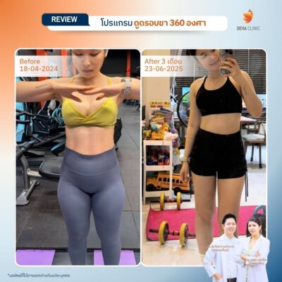 Before & After ดูดขา - ดูดไขมัน นาคนิวาส 3