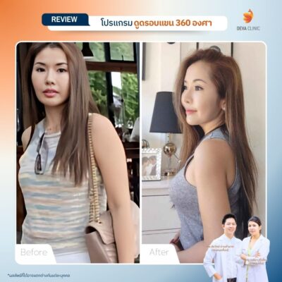 รีวิวดูดไขมันต้นแขน 5