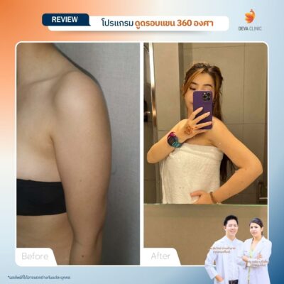 รีวิวดูดไขมันต้นแขน 6