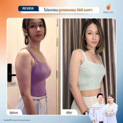 รีวิวดูดไขมันต้นแขน 8