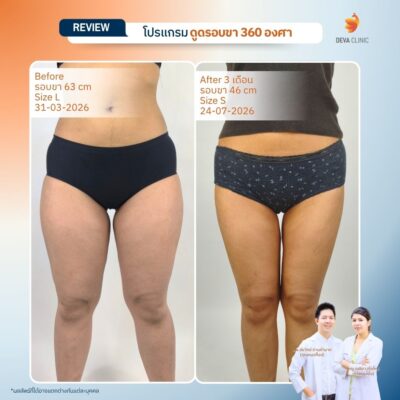 Deva Clinic รีวิวต้นขา 2