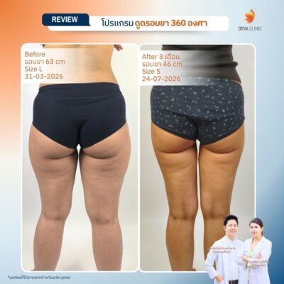 Deva Clinic รีวิวต้นขา 3