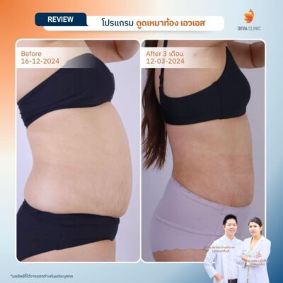 Deva Clinic รีวิวหน้าท้อง 8
