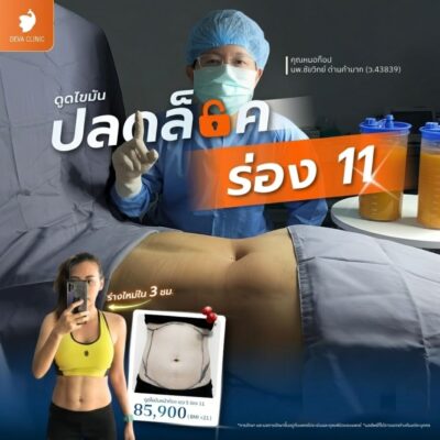รีวิวดูดไขมันหน้าท้อง เอวเอส ดีว่าคลินิก ดีไหม 02