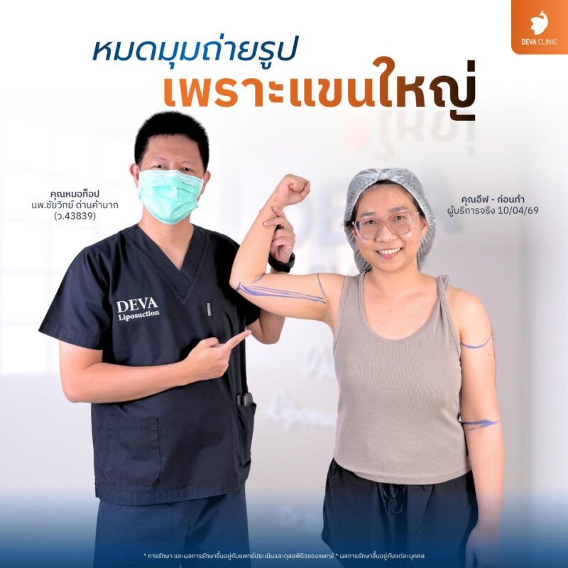 2. ดูดไขมันต้นแขน - ดูดไขมัน รัชดา 1