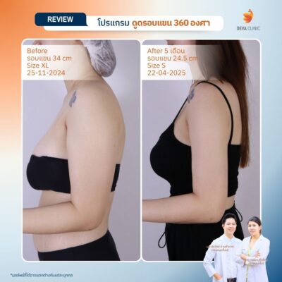 รีวิวต้นแขน - ดูดไขมัน วังหิน 12