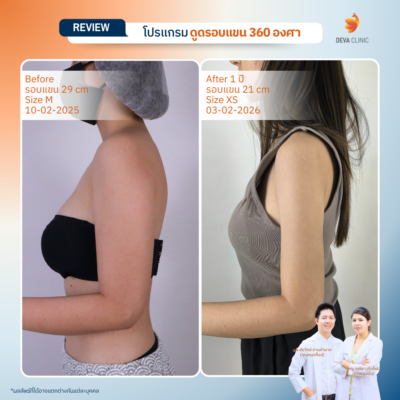 Deva Clinic รีวิวต้นแขน 18