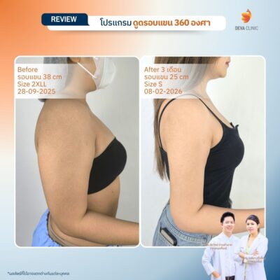 ดีว่าคลินิก รีวิว ดูดไขมันต้นแขน 360 องศา คุณหญิง 04