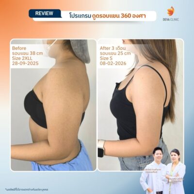 Deva Clinic รีวิวต้นแขน 1