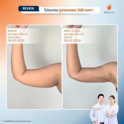 Deva Clinic รีวิวต้นแขน 17