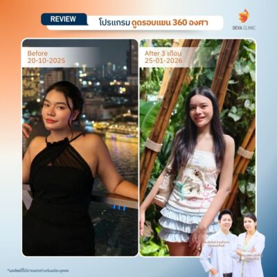 รีวิวดูดแขน ดูดไขมัน เกษตรนวมินทร์ 14
