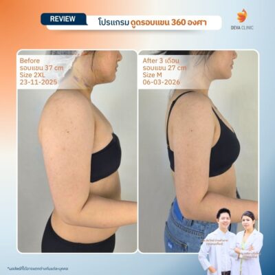 Deva Clinic รีวิวต้นแขน 16