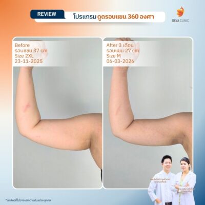 รีวิวดูดแขน ดูดไขมัน เกษตรนวมินทร์ 9