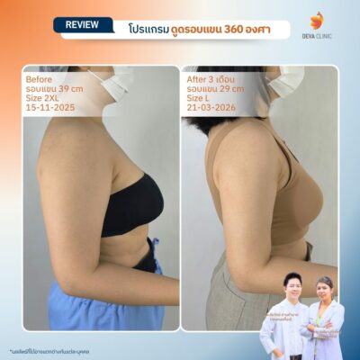 Deva Clinic รีวิวต้นแขน 15