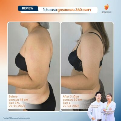 Deva Clinic รีวิวต้นแขน 14