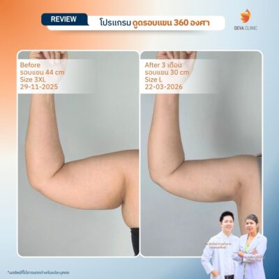 Deva Clinic รีวิวต้นแขน 13