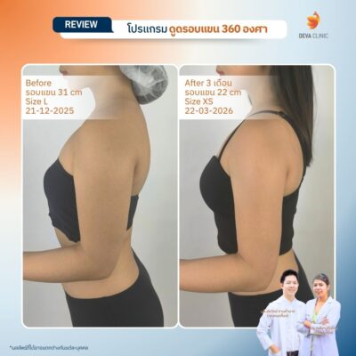 Deva Clinic รีวิวต้นแขน 11