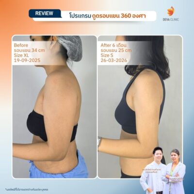 Deva Clinic รีวิวต้นแขน 12