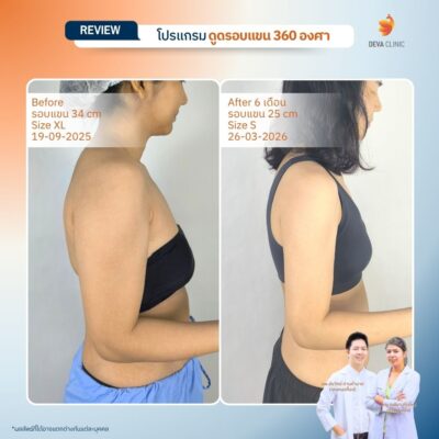 รีวิวต้นแขน - ดูดไขมัน วังหิน 15