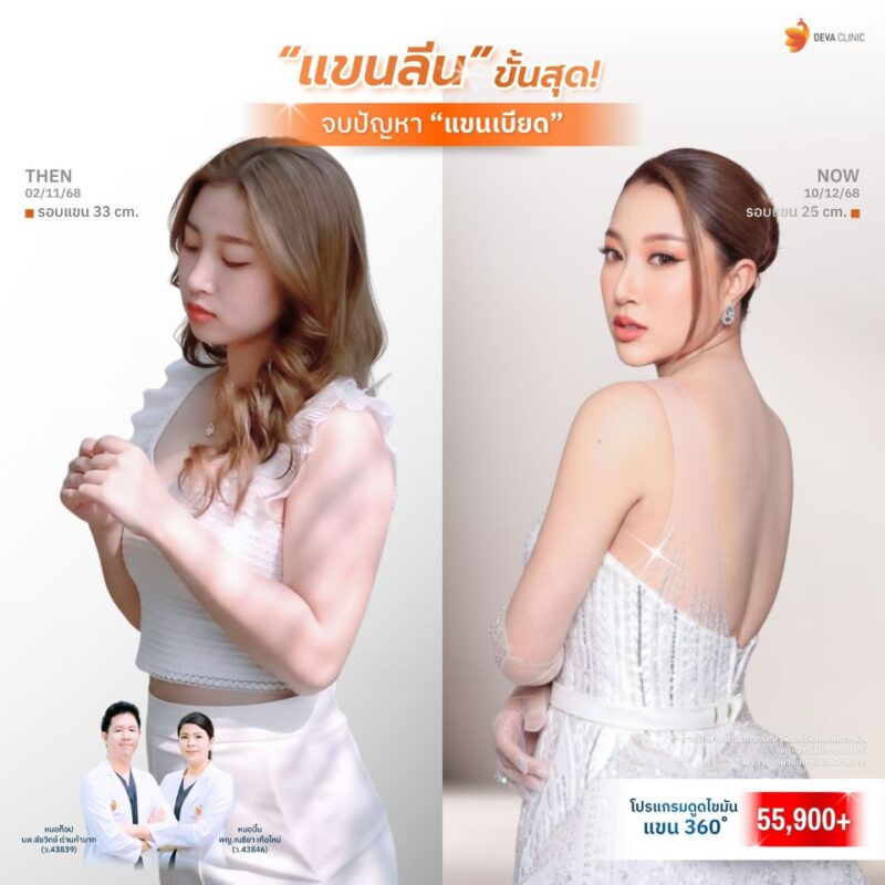 ดูดไขมันต้นแขน 360 องศา เรียวเล็กทุกมิติ - ดูดไขมัน ใกล้ฉัน