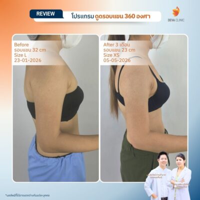 Deva Clinic รีวิวต้นแขน 10