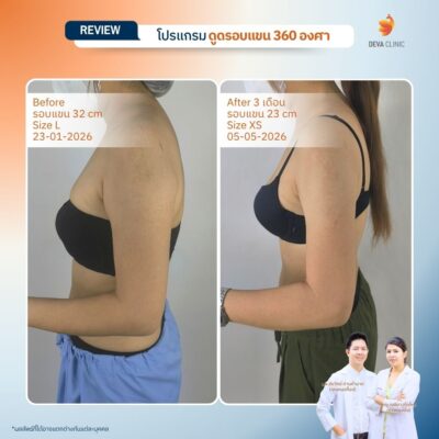 รีวิวดูดแขน ดูดไขมัน เกษตรนวมินทร์ 16