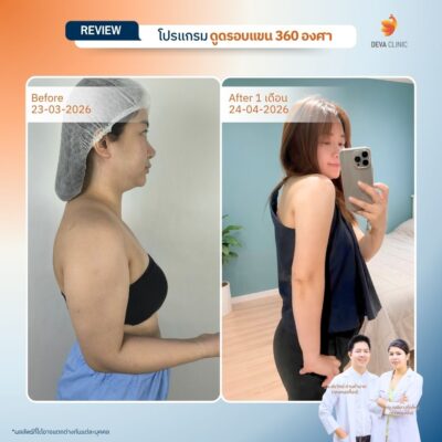 Deva Clinic รีวิวต้นแขน 8