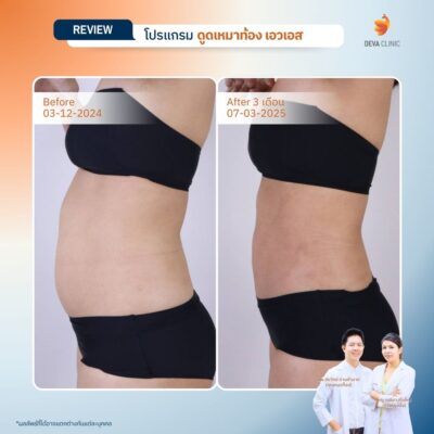 Deva Clinic รีวิวหน้าท้อง 3