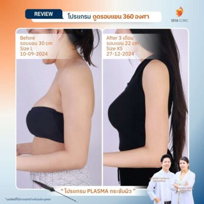 รีวิวดูดแขน ดูดไขมัน เกษตรนวมินทร์ 2
