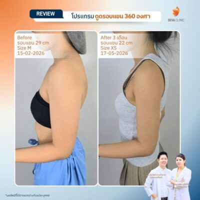 Deva Clinic รีวิวต้นแขน 7