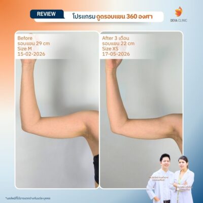 Deva Clinic รีวิวต้นแขน 9