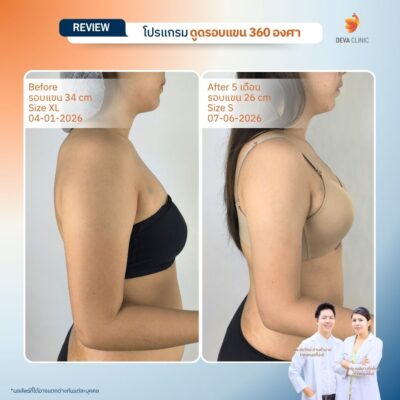 รีวิวดูดต้นแขน ดูดไขมัน ลาดพร้าว 71 17
