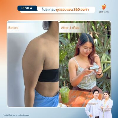 Deva Clinic รีวิวต้นแขน 5