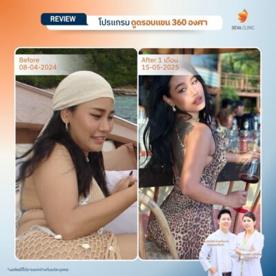 รีวิวต้นแขน - ดูดไขมัน วังหิน 1