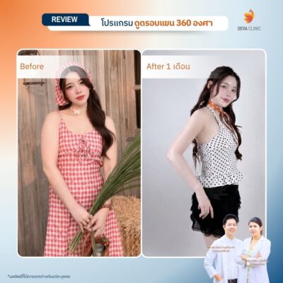 Deva Clinic รีวิวต้นแขน 4