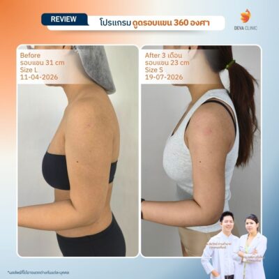 Deva Clinic รีวิวต้นแขน 3