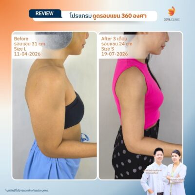 Deva Clinic รีวิวต้นแขน 2