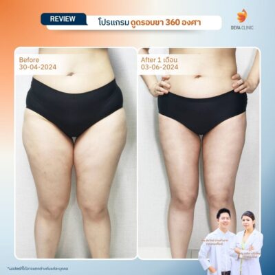 รีวิวเคสดูดไขมันขาเรียวสวย ดูดไขมันโชคชัย 4 8