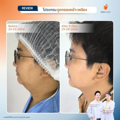 รีวิวดูดหน้าเหนียง ดูดไขมัน ลาดพร้าว 71 8